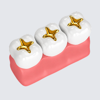 세라믹 (e-max inlay)